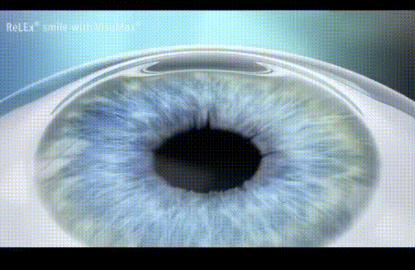 스마일 라식