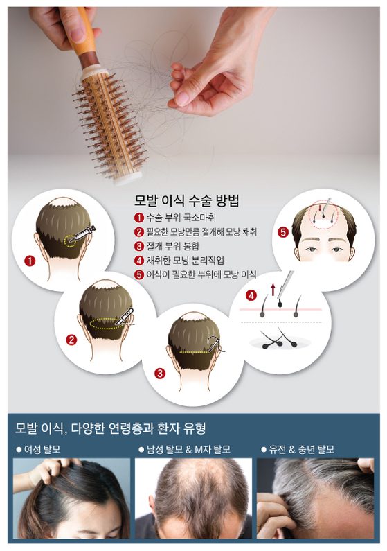 탈모, 모발이식, 모발이식비용