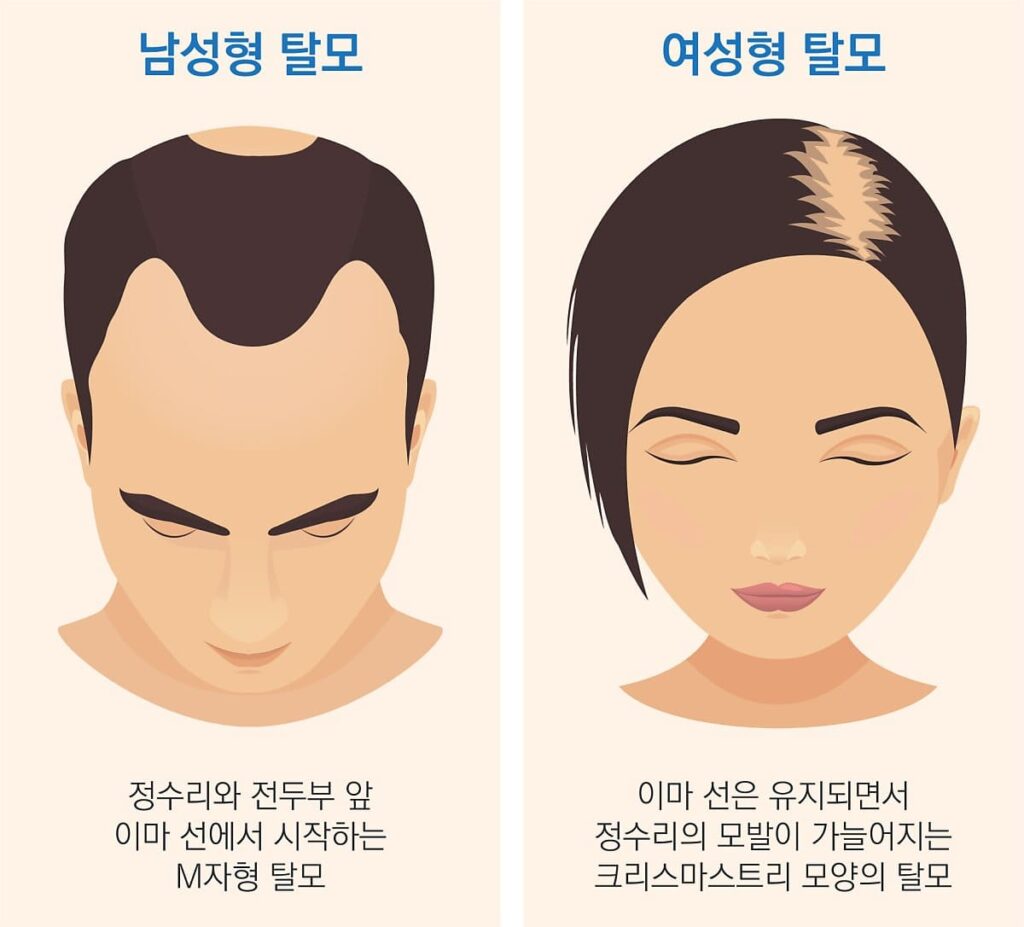 모발이식, 모발이식비용, 남성탈모,여성탈모,탈모